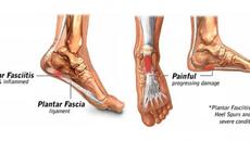 4 начина да подобрите възпалението на Плантарният фасцит – коварният удар под… петата (Видео) - Videoclip.bg