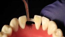 Вижте как се конструира зъб директно на мястото на липсващият ви! Ribbond Single Visit Bridge Technique - Videoclip.bg