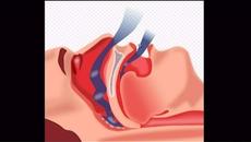 Обструктивна сънна апнея - причини, проява и лечение - Videoclip.bg