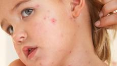 Морбили - причини за болестта, симптоми и лечение! Какво е това морбили - “летяща инфекция”!? - Videoclip.bg