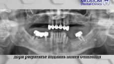 Поставяне на Зъбни импланти от Implantmedstom - Videoclip.bg