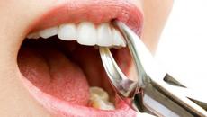 След вадене на зъб какво да правим - Лечение и възстановяване - Videoclip.bg