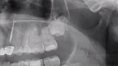 След екстракцията на мъдрец усещането какво е!? А ако е и ретениран е още по-сериозно - Videoclip.bg