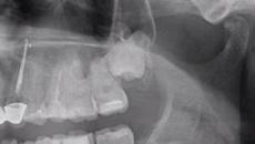 Отстраняване на ретиниран мъдрец -  Impacted Tooth Removal - Videoclip.bg